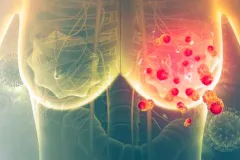 Cáncer de mama: 80% de los casos ocurre sin riesgos específicos, dice OMS