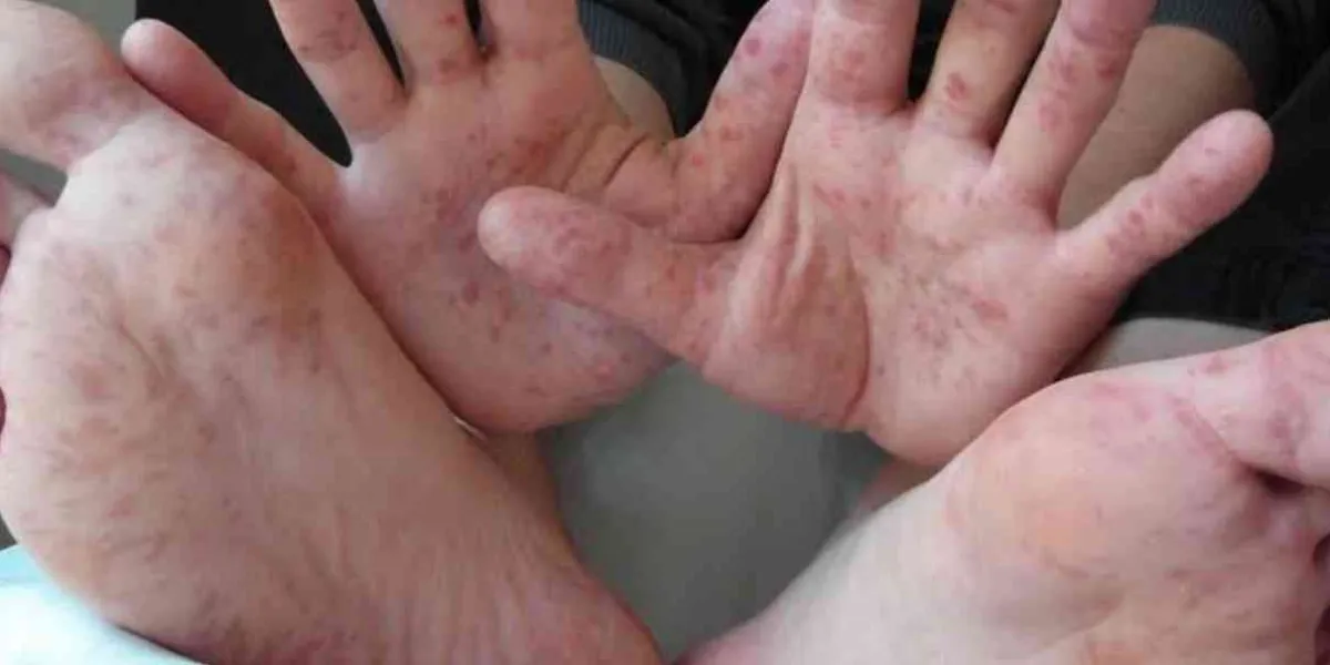 Registran 72 casos del virus Coxsackie