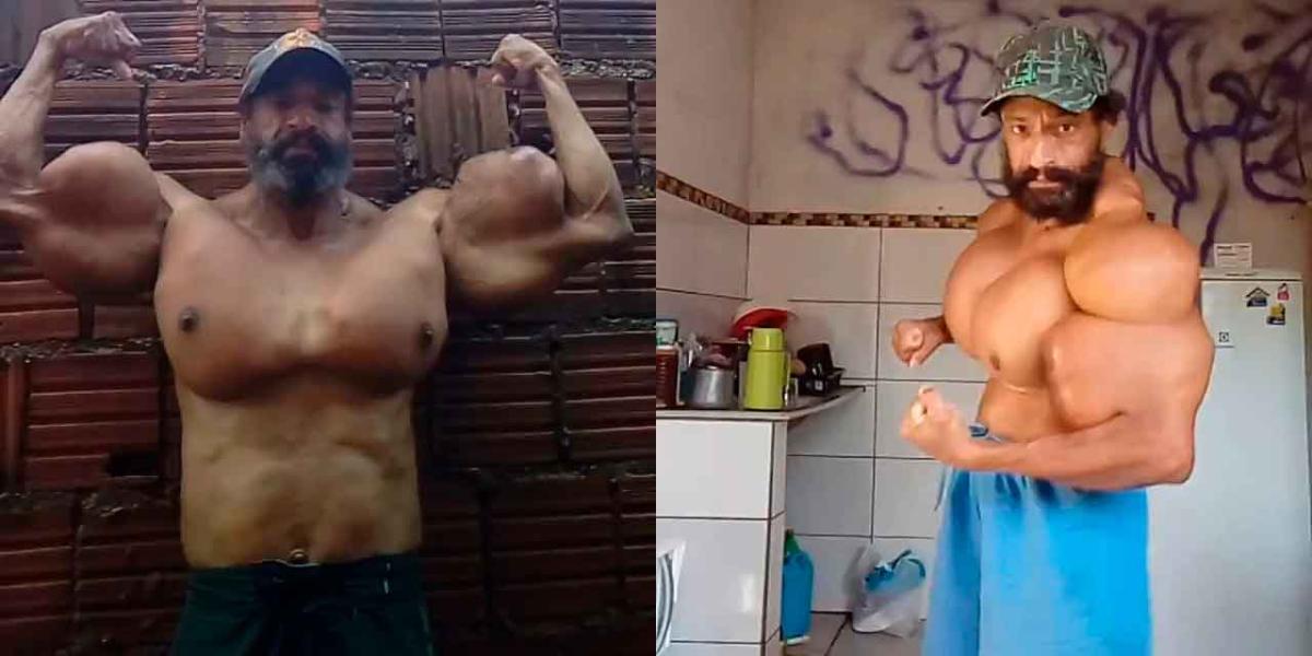 Muere Valdir Segato el “Hulk” brasileño, hombre que se inyectaba aceite para aumentar sus músculos